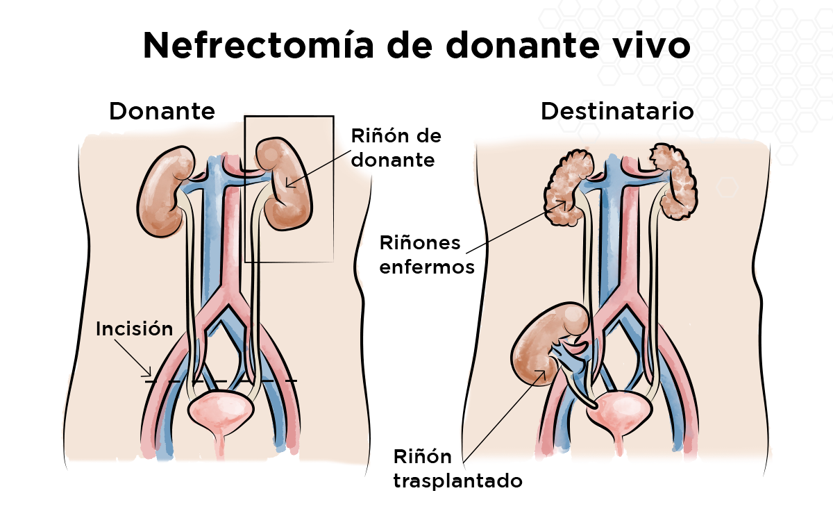 Nefrectoma de donante vivo